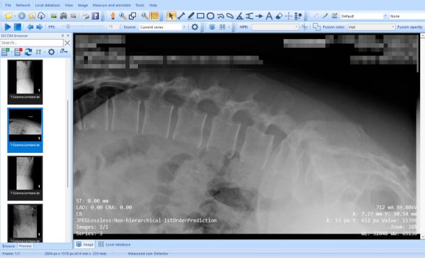 interfaccia MicroDicom DICOM viewer